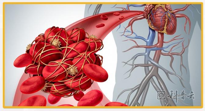 血栓到底是怎么形成的?